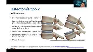 SPINE WEBINAR 70 OSTEOTOMIAS PARA CORRECCION DE DEFORMIDADES ESPINALES [upl. by Ys]