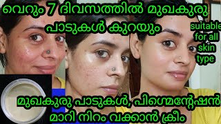 OMG Remove pimple marks and dark spots just 7 days Natural homemade cream for pimple marks darkspot [upl. by Linoel]