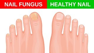 Simple Home Remedies for Toenail Fungus [upl. by Cerelia]