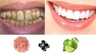 COMO BLANQUEAR LOS DIENTES EN 2 MINUTOS REMEDIO CASERO [upl. by Enohpets]