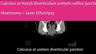 Calculus at Hutch diverticulum  ureteric orifice junction Meatotomy  Laser Lithotripsy [upl. by Hgielra]