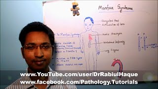 Marfan Syndrome  Part 1 HD [upl. by Sterling765]