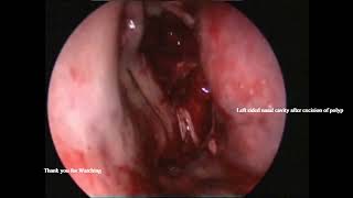 Left sided antrochoanal polyp before and after surgery [upl. by Susette]