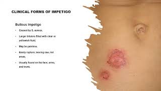 Impetigo A highly Contagious Bacterial Skin Infection [upl. by Htiduj]