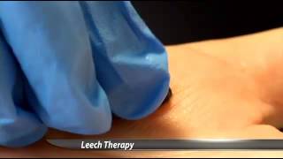 Hospital Uses Leeches to Heal Patients [upl. by Noived923]