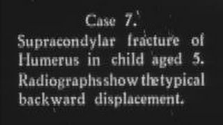 Recent advances in fracture treatment Part 5 c1932 [upl. by Glynda623]