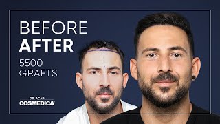 Hair Transplant in Turkey  Results  Dr Acar  Cosmedica Clinic [upl. by Lilybelle]