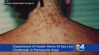 Department Of Health Warns of Sea Lice Outbreak [upl. by Nylarad]