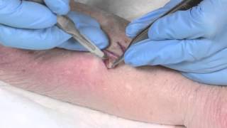 How to Suture  part 4 the Z plasty [upl. by Asyen]