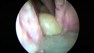 Left Antrochoanal polyp by Prof Dr Mohamed M ElSawy MD [upl. by Aridaj]