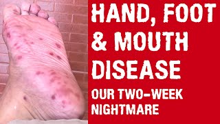 Hand Foot and Mouth Disease Documentary  Our TwoWeek Nightmare [upl. by Rasecoiluj]