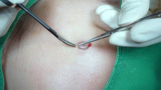 Intradermal Nevus Big Mole Removal Surgery HD 젊은 여성의 얼굴 광대 부위의 큰 점 진피내모반 제거 수술 수원 광교 유디트 성형외과 [upl. by Riker]