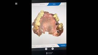 Before and after  dental implant  All on X implant [upl. by Cornie254]