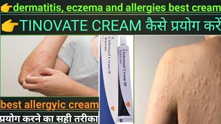 dermatitis eczema and allergies।।Tenovate cream।।best skin cream।।hindi review [upl. by Jenne]