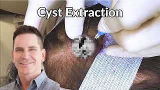 Pearl Shaped Cyst Excavated from Scalp  CONTOUR DERMATOLOGY [upl. by Nosaj]