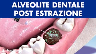 ALVEOLITE DENTALE post estrazione del dente  Cause e trattamento © [upl. by Teragramyram]