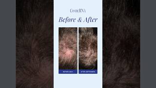 Revolutionary Antihair loss tonic beforeamp after cosmerna [upl. by Loma998]