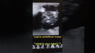 Supraumbilical mass Whats your take [upl. by Norris810]