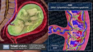 Progression of Chorioamnionitis and its Effects on the Fetal Brain [upl. by Arlena432]