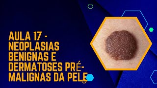 Aula 17  Neoplasias benignas e Dermatoses prémalignas [upl. by Cadel]