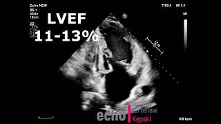 Late cardiotoxicity AC amp RTx Hodgkins disease heart failure GLS Global Longitudinal Strain 45 [upl. by Peyton830]