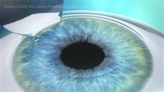 Femto LASIK  die sanfte und sichere LASIK [upl. by Akeenahs]