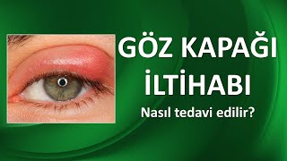 BLEFARİT GÖZ KAPAĞI İLTİHABI NEDİR NASIL TEDAVİ EDİLİR [upl. by Gilbertson]