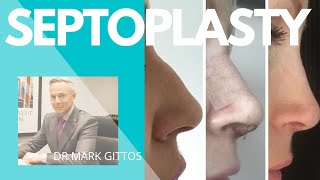 Septoplasty [upl. by Mirak]