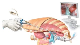 Minimal invasive surgery for lung cancer [upl. by Llerdnod]