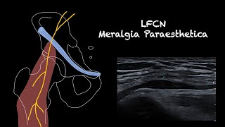 Ultrasound of the Lateral Femoral Cutaneous NerveMeralgia Paraesthetica [upl. by Aggappora517]