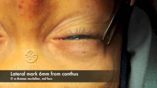 Live Surgery Upper Blepharoplasty Eyelid Lift Part 1 Markings and Anesthesia [upl. by Weidman]