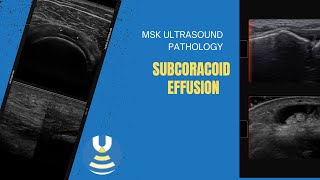 Subcoracoid effusion demonstrated on shoulder ultrasound [upl. by Alien343]