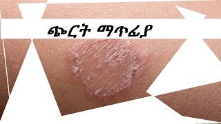 ጭርትን በተፈጥሯዊ መንገድ ማጥፊያget rid of Ringworm naturally [upl. by Babby644]