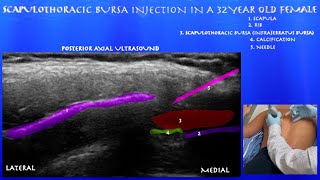 Ultrasound Guided Scapulothoracic Bursa Injection in a 32 Year Old Female by probeultrasoundcom [upl. by Yennek250]