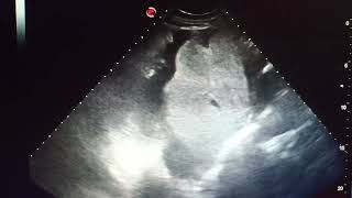 Échographie abdominale Ascite de grande abondance [upl. by Safoelc526]