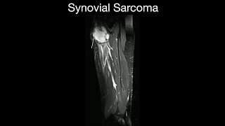 Synovial Sarcoma [upl. by Lampert]