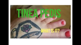 TINEA PEDIS  WHAT IS IT \\ Rayn Beauty [upl. by Farron]