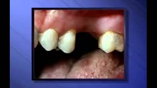 Partial Upper Denture  Miskin Ajax Dental [upl. by Iclehc]