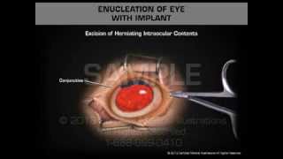 Enucleation of Eye with Implant [upl. by Ynaffyt]