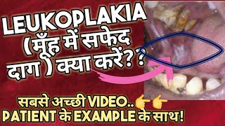 Leukoplakia in hindiमुँह में सफेद दाग हैं तो क्या ईलाज करेंTreatmentOral thrushOSMFOral Cancer [upl. by Ecinuahs]