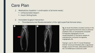 Acute Limb Ischemia [upl. by Aeila577]