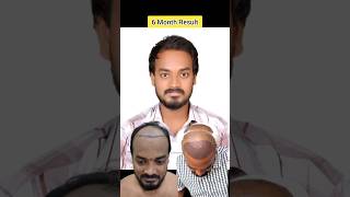 6 Month Hair Transplant Result I Expected shortvideo shortsfeed hairtransplant shorts short [upl. by Anerdna55]