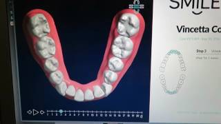 Smile Direct Club Journey My 3D Treatment plan [upl. by Neraj]