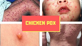 What is Chicken pox Pictures Signs and Symptoms of Chickenpox Virus Varicella [upl. by Burck813]