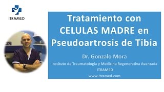 TRATAMIENTO CON CELULAS MADRE EN PSEUDOARTROSIS DE TIBIA [upl. by Ahsineg683]