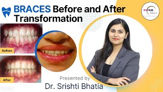 MAGICAL Braces Before and After Transformation Dr Srishti Bhatia braces smilemakeover [upl. by Ernald]