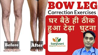 Bow Legs Correction Exercises  Bow leg correction at home  How to fix bowed legs [upl. by Oniger]