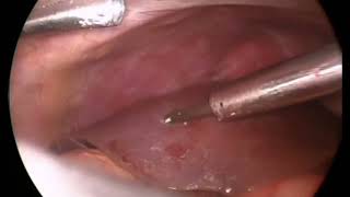 Laparoscopic Cholecystectomy 24 [upl. by Arahk888]