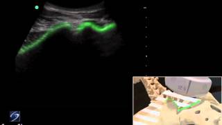 Démo 3D  infiltration échoguidée de larticulation sacroiliaque  Échographe SonoSite [upl. by Inalej]