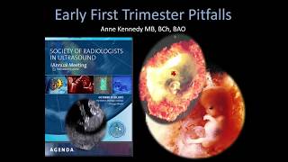 SonoWorld Early First Trimester Pitfalls [upl. by Neville661]